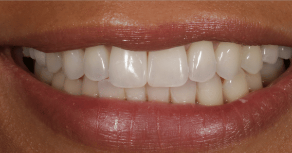 After - North Down Dental