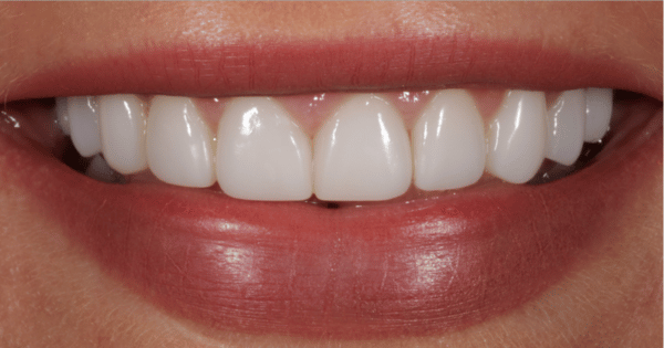 After - North Down Dental