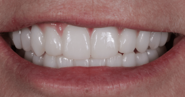 After - North Down Dental