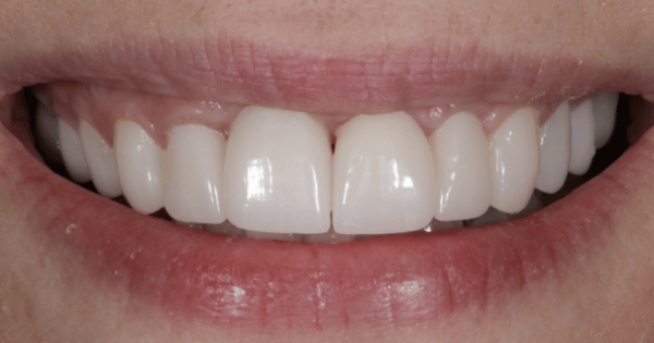 After - North Down Dental